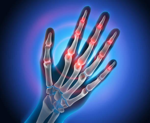 Arthritis